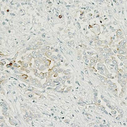 Epithelioid Mesothelioma