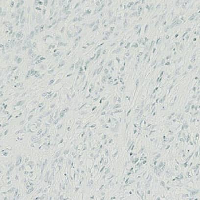 Sarcomatoid Mesothelioma